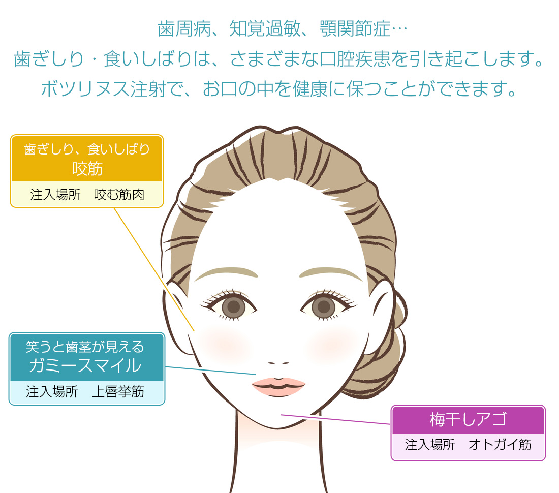 ボツリヌス治療・歯ぎしり・食いしばり